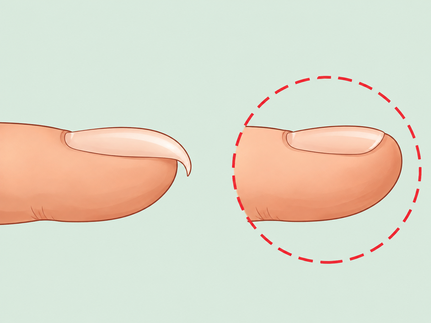 Side view comparing a normal fingertip with a rounded clubbed fingertip.