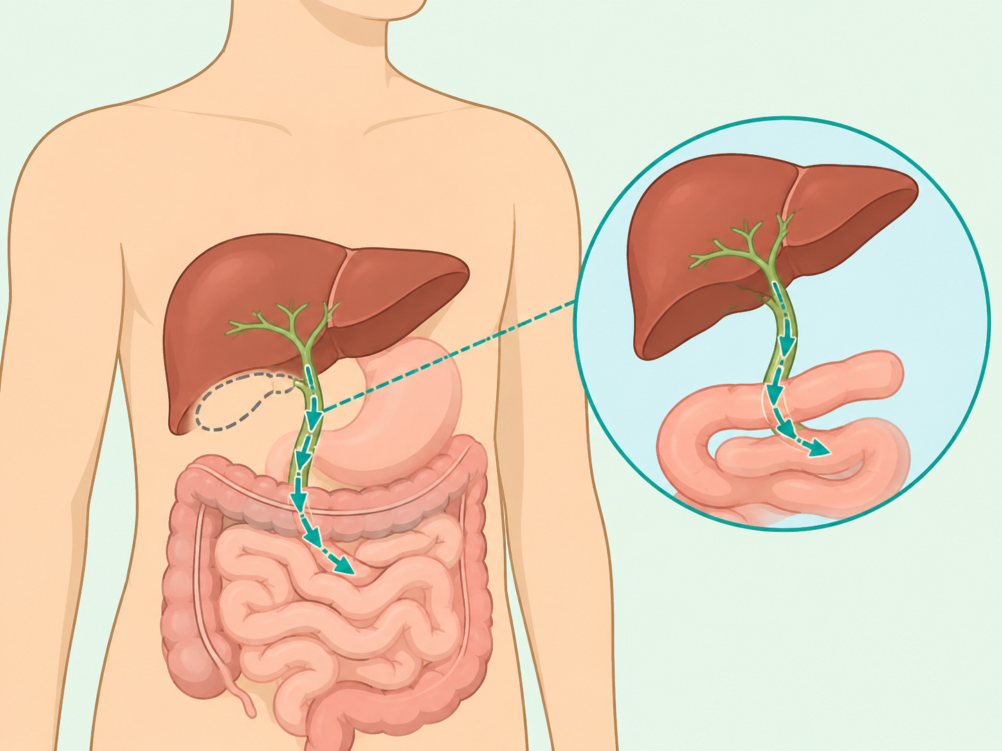 Illustration showing bile flowing from the liver to the intestine after gallbladder removal.