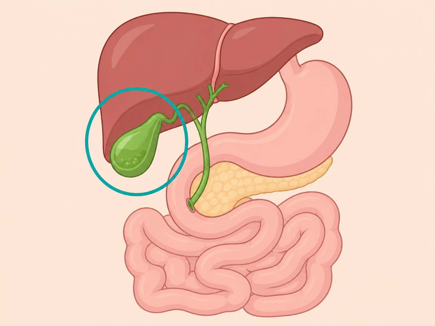 Diagram of the gallbladder storing bile before removal.