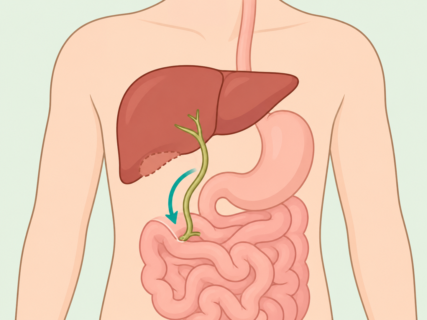Bile flowing directly from the liver to the small intestine after gallbladder removal.